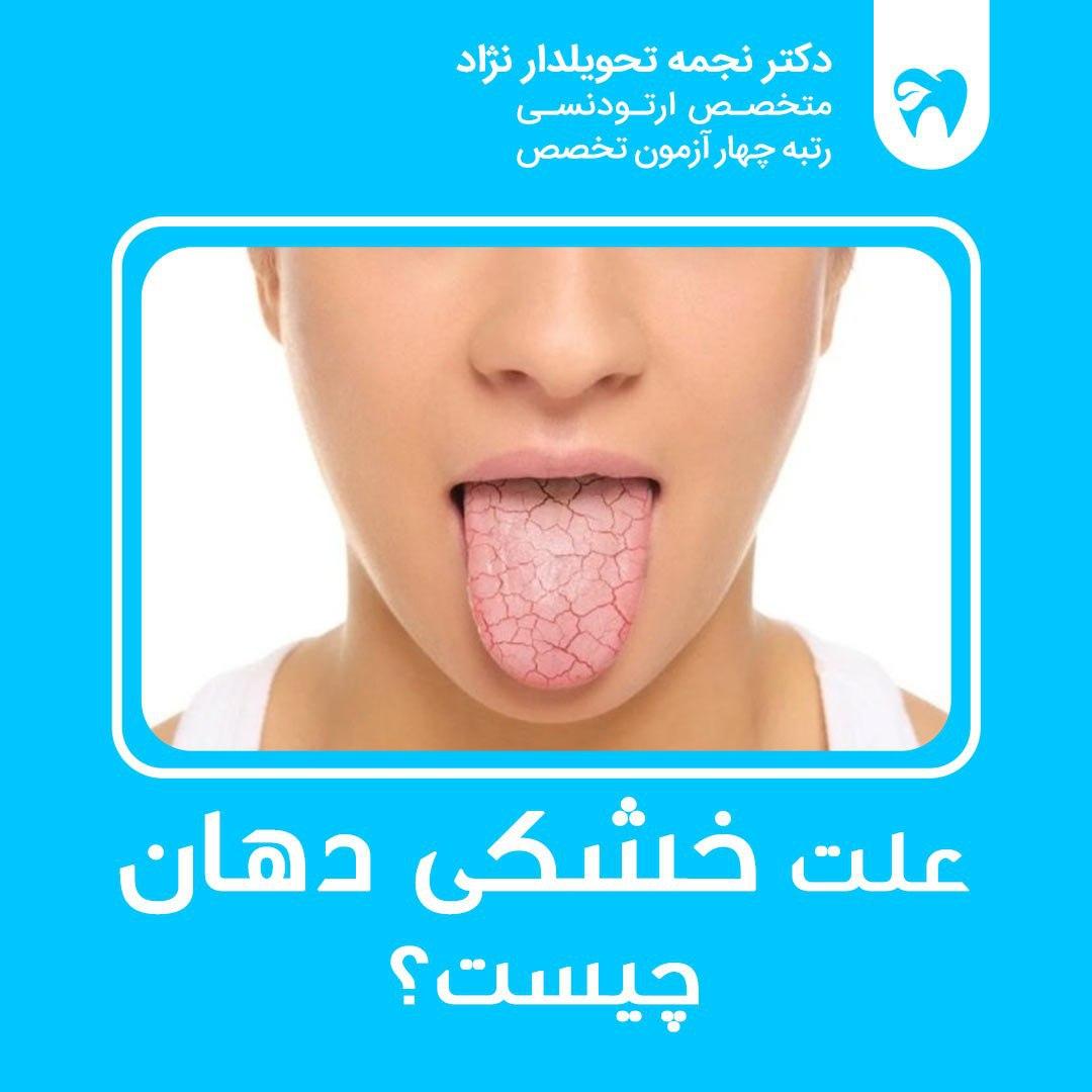 خشکی دهان چیست؟
