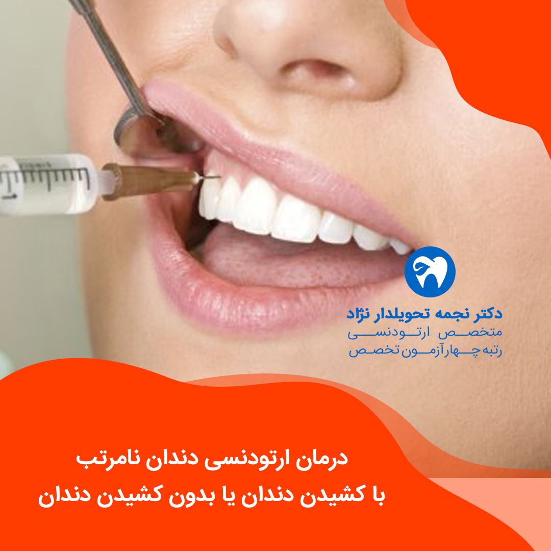 درمان ارتودنسی دندان نامرتب با کشیدن دندان یا بدون کشیدن دندان