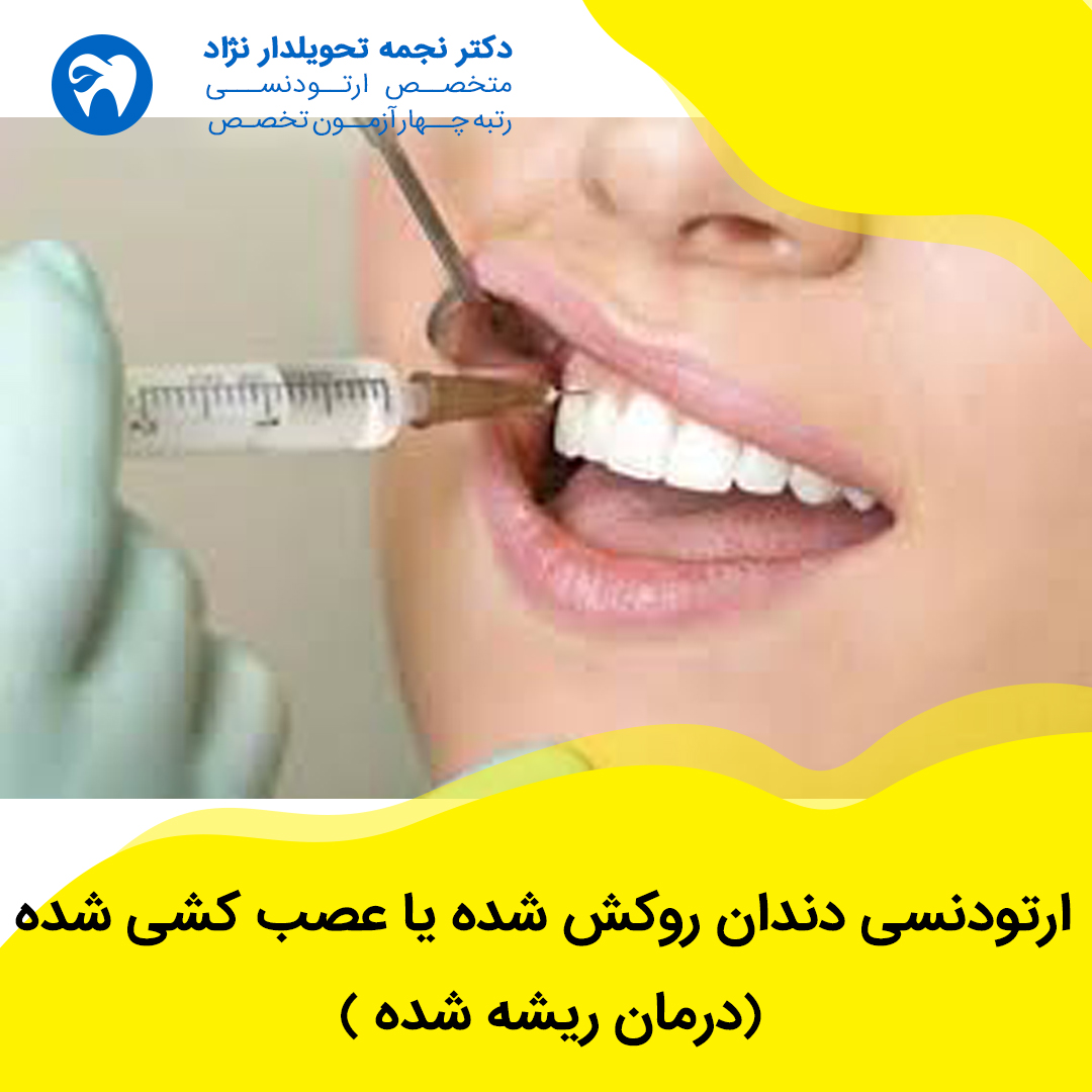 ارتودنسی دندان روکش شده یا عصب کشی شده