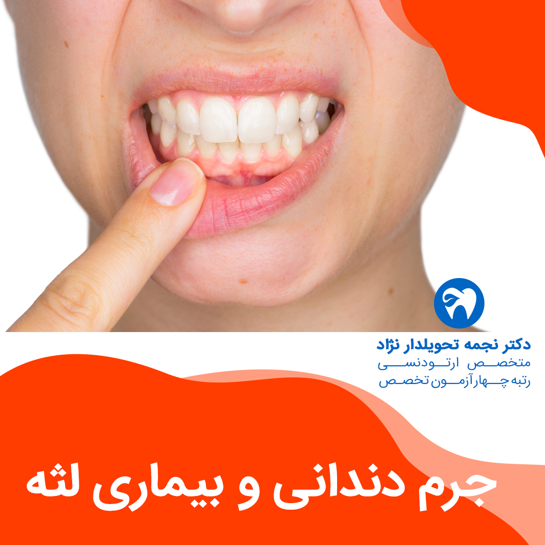جرم دندانی و بیماری لثه