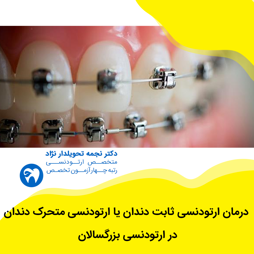 درمان ارتودنسی ثابت دندان یا ارتودنسی متحرک دندان در ارتودنسی بزرگسالان
