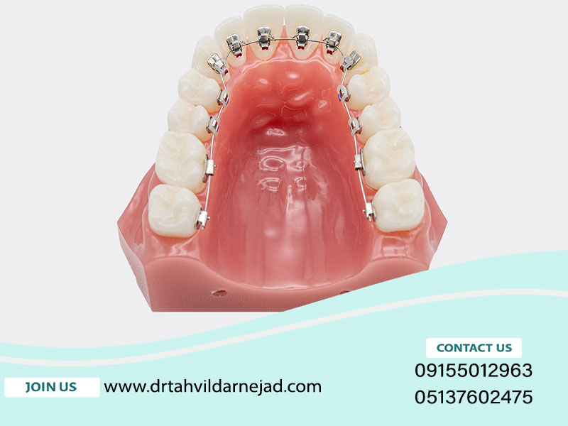 ارتودنسی لینگوال چیست