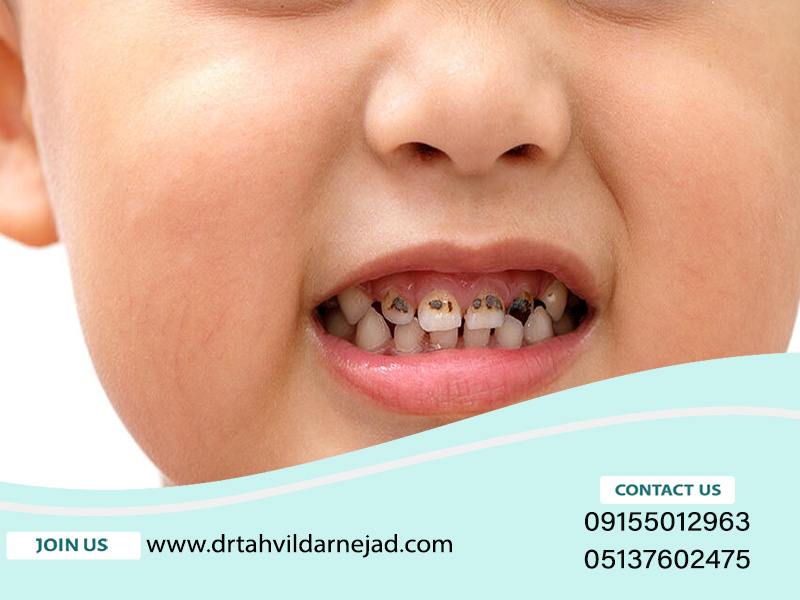 چرا دندان کودکان زود خراب می شوند؟