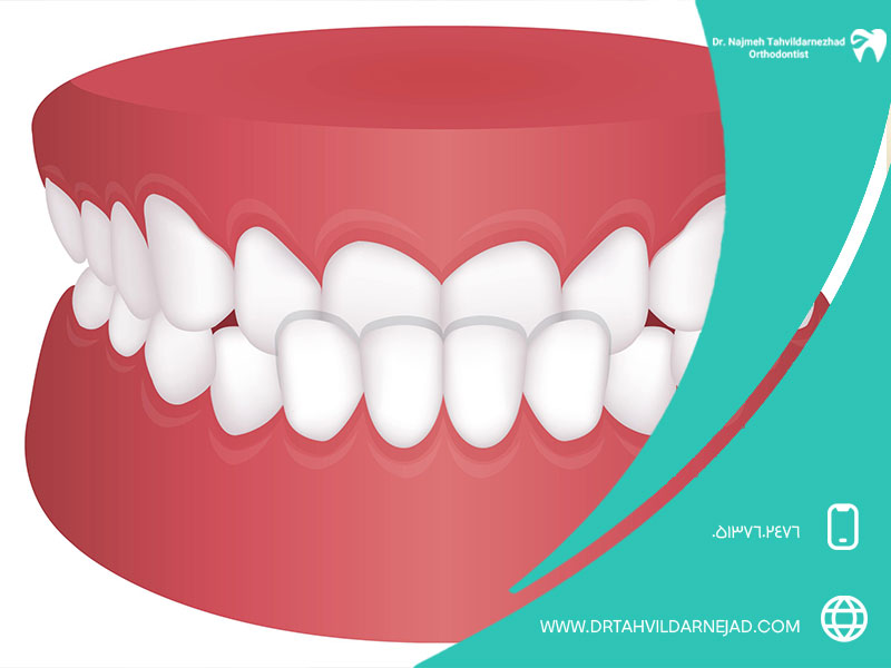 آندربایت چیست و چرا رخ می‌دهد؟
