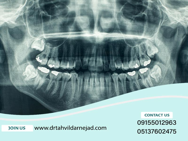 دلایل نیاز به رادیولوژی دهان و دندان چیست؟