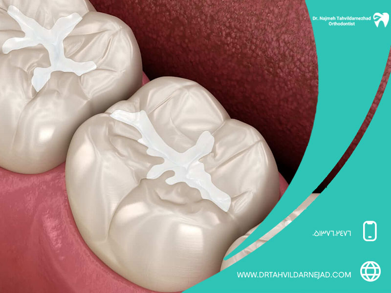 شیار پوش دندان چیست و چگونه عمل می‌کند؟