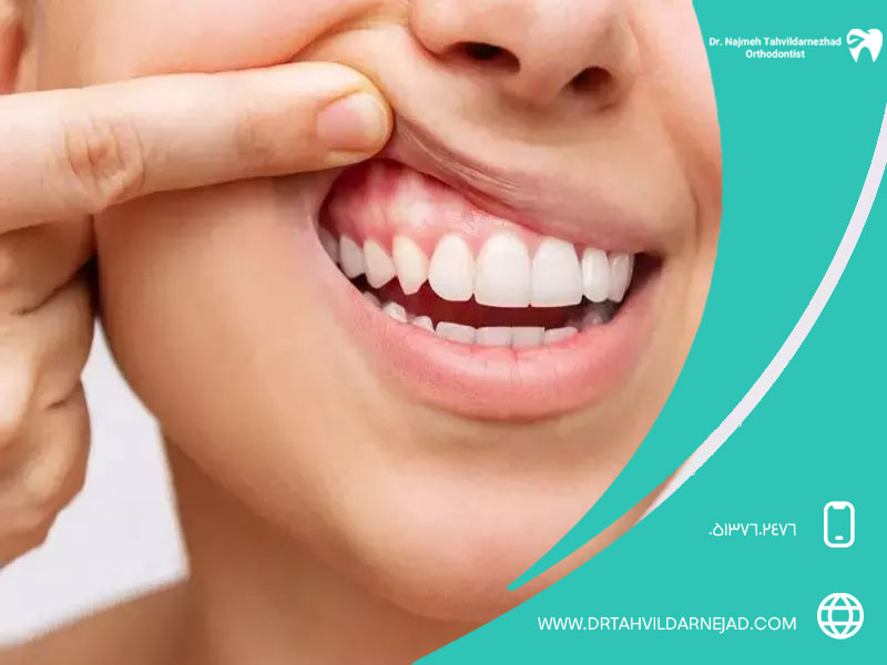 مهم‌ترین دلایل تحلیل لثه کدامند؟