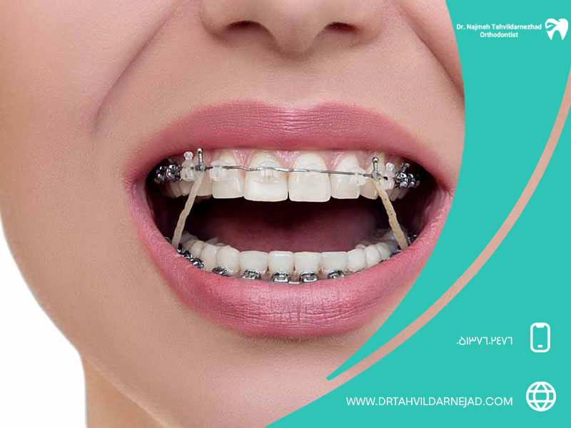 بعد از شکستن براکت ارتودنسی چکار باید کرد؟
