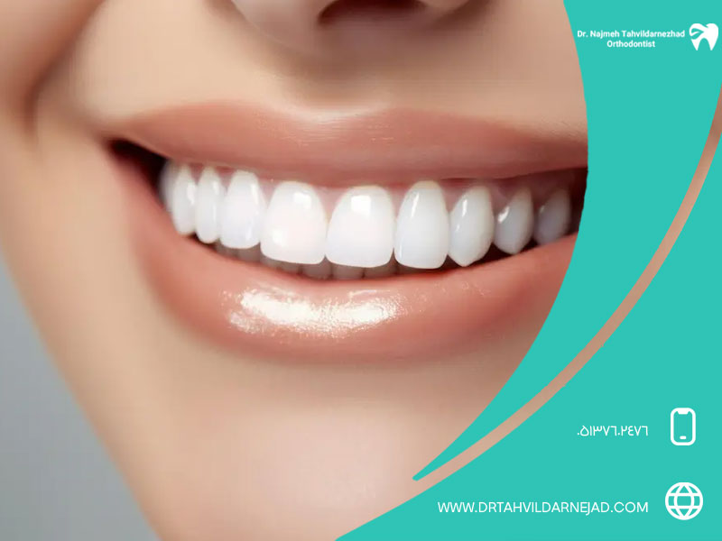لمینت دندان چیست؟