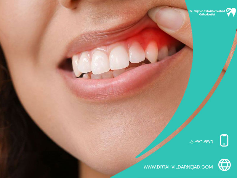 ۸. عوامل افزایش‌دهنده احتمال ابتلا به بیماری لثه