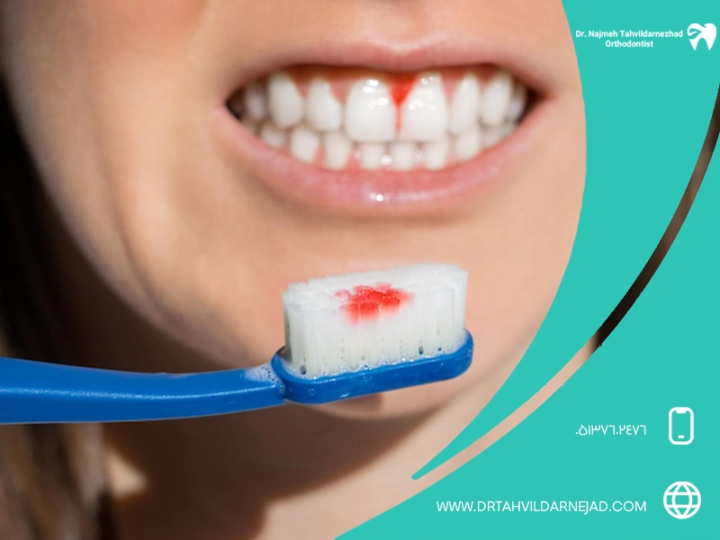 بررسی مهم‌ ترین علل خونریزی لثه