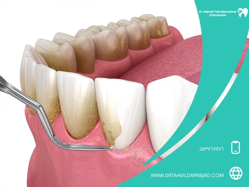 جرم دندان چیست و چرا تشکیل می‌شود؟