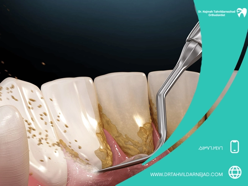 آیا جرم‌گیری زیاد به دندان آسیب می‌زند؟