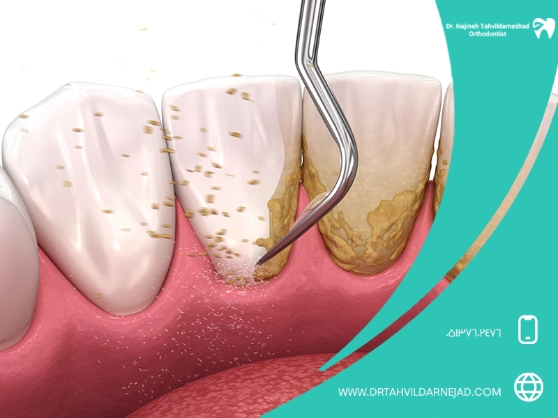  جرم دندان چیست و چرا تشکیل می ‌شود؟