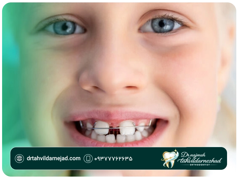 دیاستم (Diastema) چیست؟