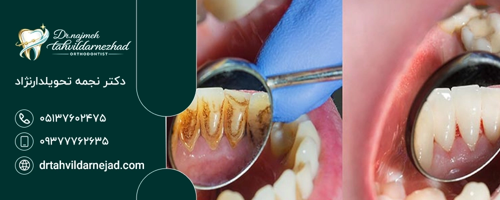 آیا جرم‌گیری باعث ضعیف شدن دندان می‌شود؟