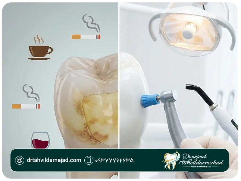 علل تغییر رنگ کامپوزیت + روش‌های جلوگیری و اصلاح